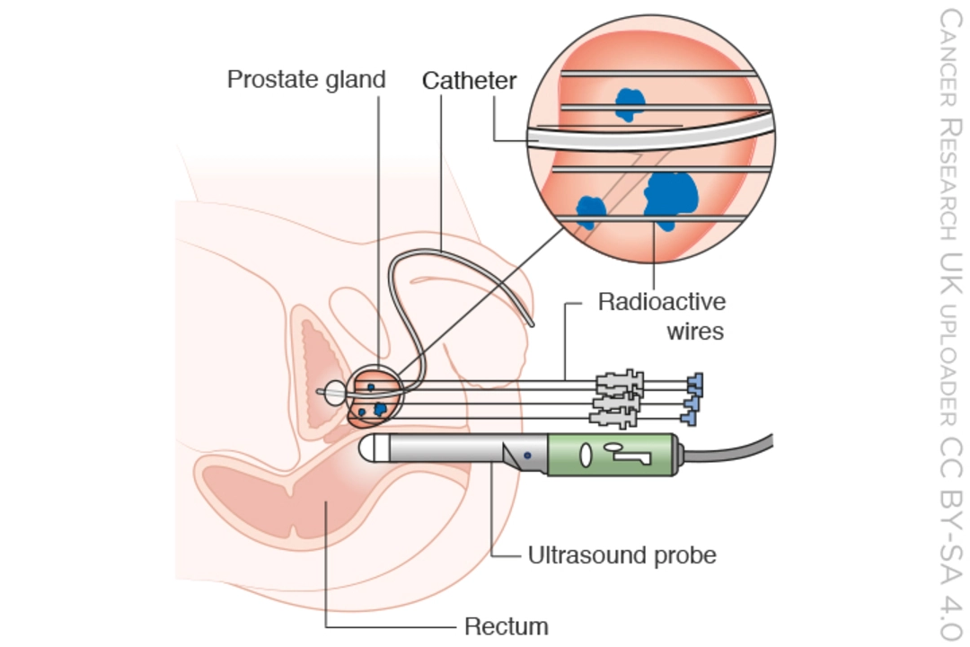 Abiratérone et son rôle dans le cancer de la prostate résistant à la castration