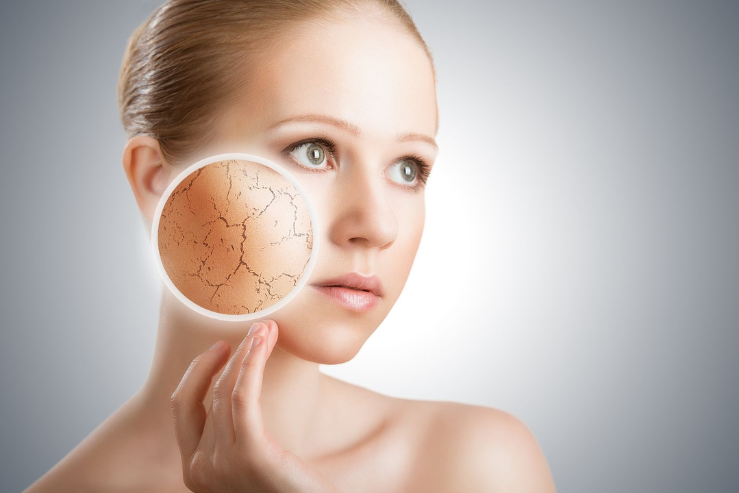 Comment prévenir l'acné : Astuces pour une peau saine et nette